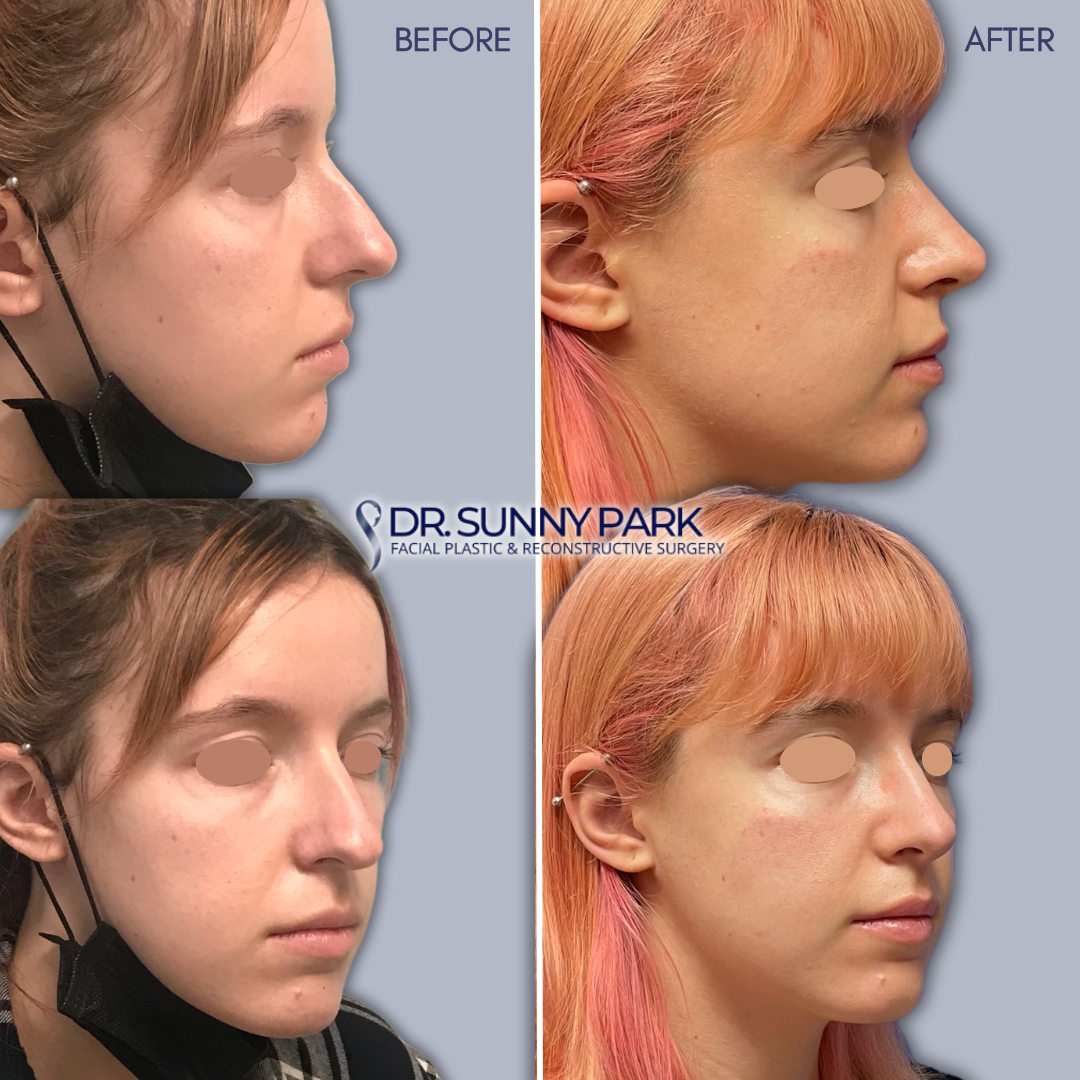 Before-and-After Facelift Results - Dr. Sunny Park | Top Plastic